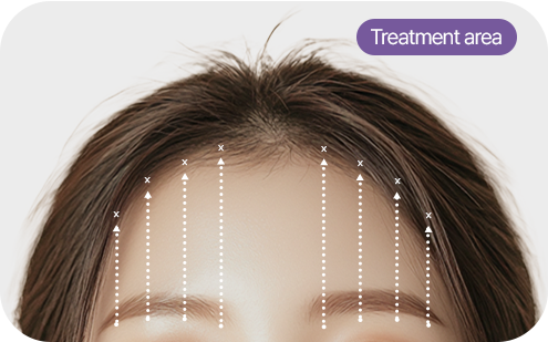 Eyebrow lifting image