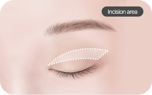 Upper eyelid surgery images