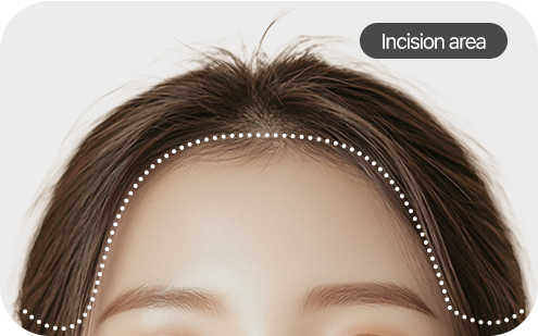 Forehead augmentation surgery image