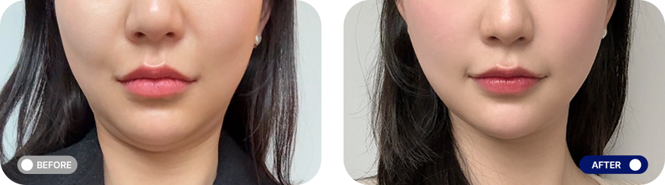 Titanium lifting before and after photos