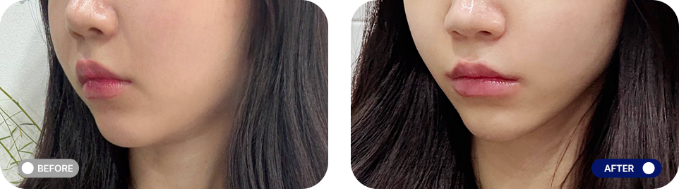 Titanium lifting before and after photos
