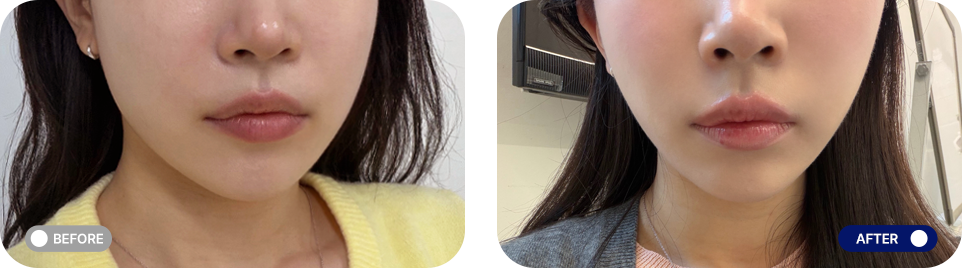 Titanium lifting before and after photos