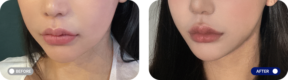 Titanium lifting before and after photos