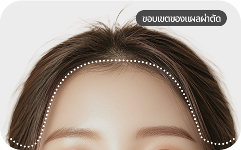 ภาพการผ่าตัดยกกระชับหน้าผาก