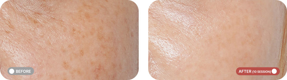 클라리티2 전후사진