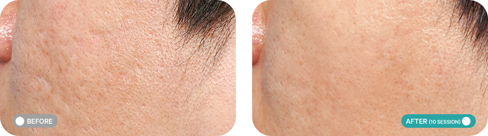 포텐자 전후사진