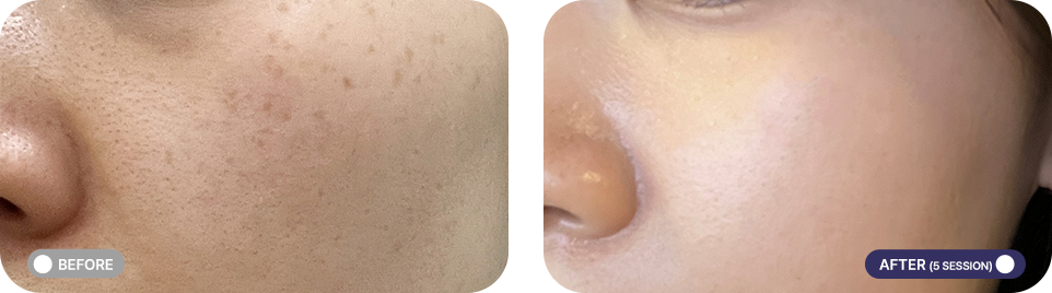 레블라이트 전후사진