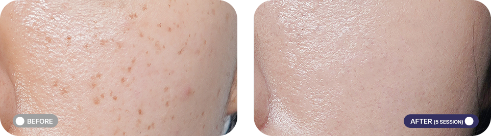 레블라이트 전후사진