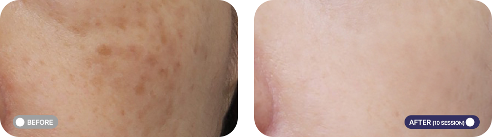 레블라이트 전후사진