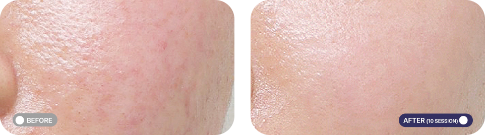 레블라이트 전후사진