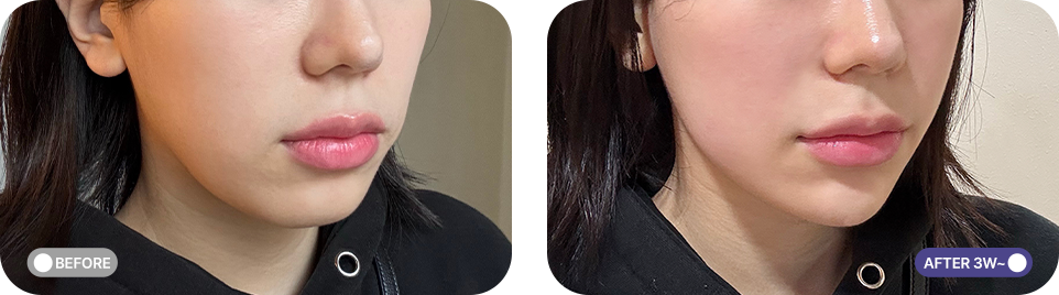 슈링크 유니버스 전후사진