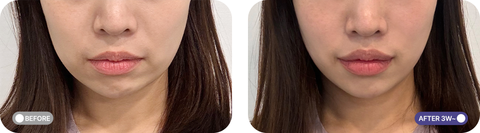 슈링크 유니버스 전후사진