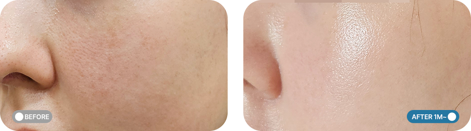 스킨바이브 전후사진