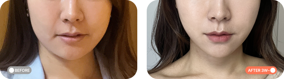 텐써마리프팅 전후사진