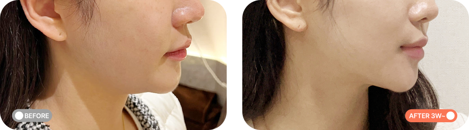 텐써마리프팅 전후사진