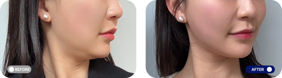 티타늄리프팅 전후사진