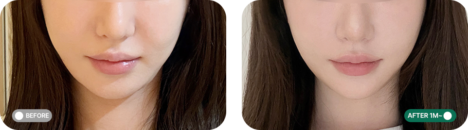 울쎄라프라임 전후사진