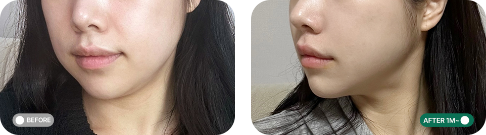 울쎄라프라임 전후사진