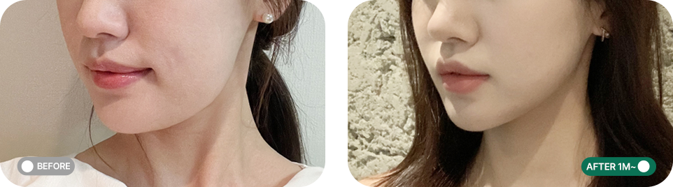 울쎄라프라임 전후사진