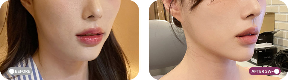 볼뉴머 리프팅 전후사진