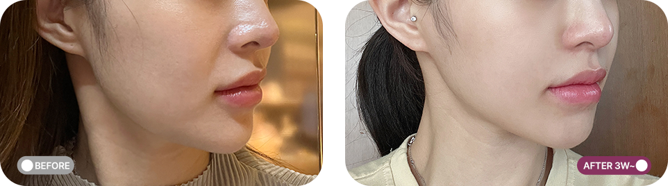 볼뉴머 리프팅 전후사진