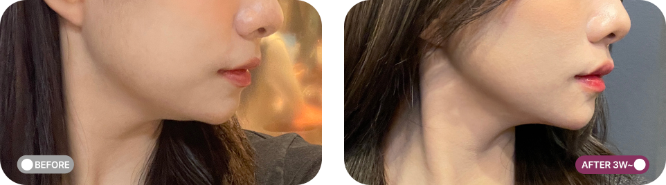 볼뉴머 리프팅 전후사진