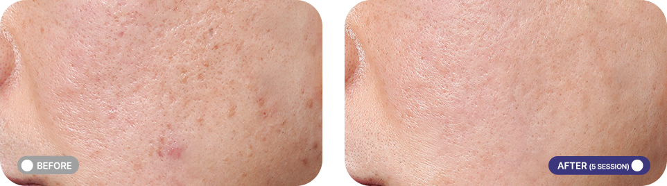 큐어젯 전후사진