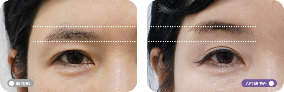 눈썹거상리프팅 전후사진