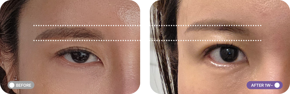 눈썹거상리프팅 전후사진