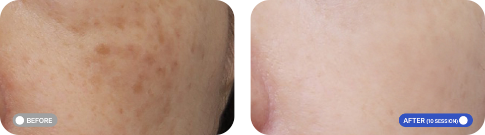 GV 레이저 전후사진