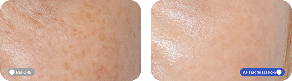 GV 레이저 전후사진