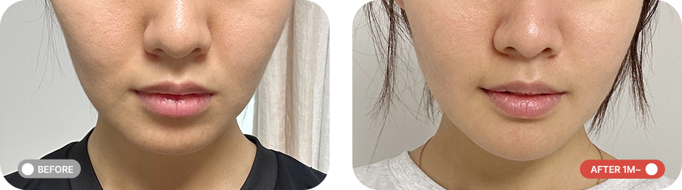 중안부축소리프팅 전후사진