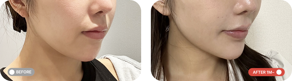 중안부축소리프팅 전후사진