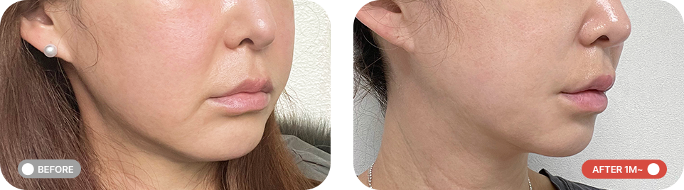 중안부축소리프팅 전후사진