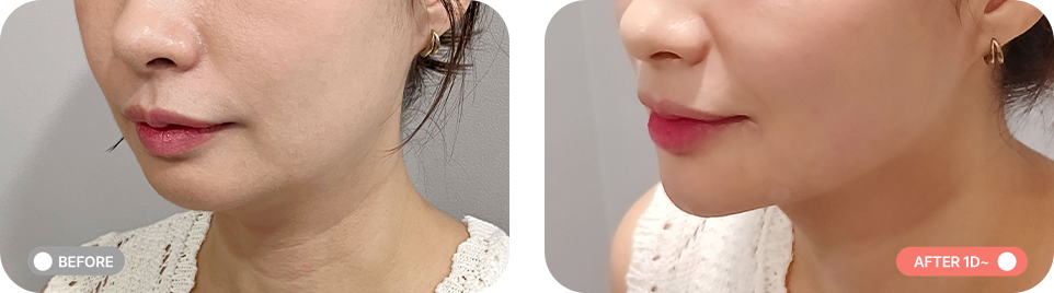 무턱패키지 전후사진