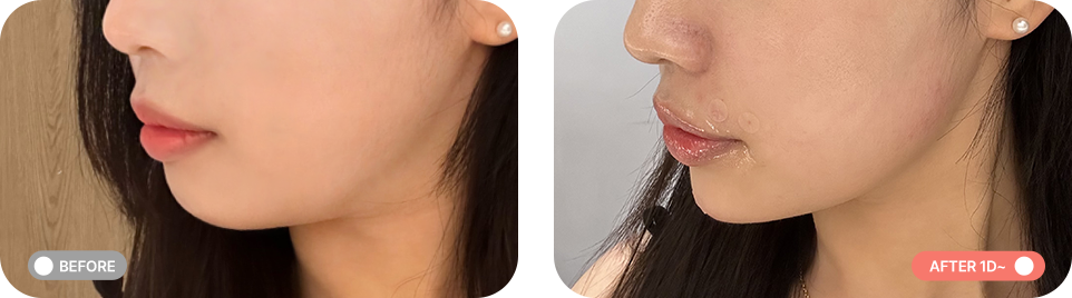 무턱패키지 전후사진