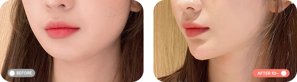 무턱패키지 전후사진