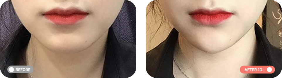 무턱패키지 전후사진