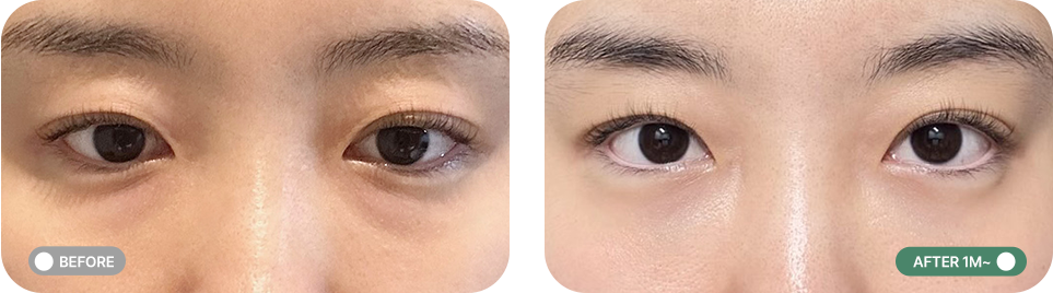 비절개 눈밑 지방교정 전후사진