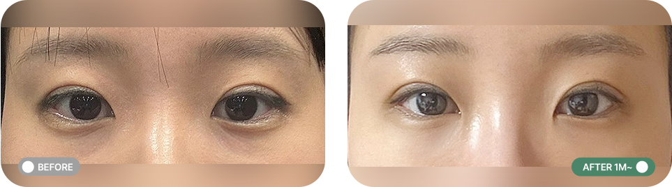 비절개 눈밑 지방교정 전후사진