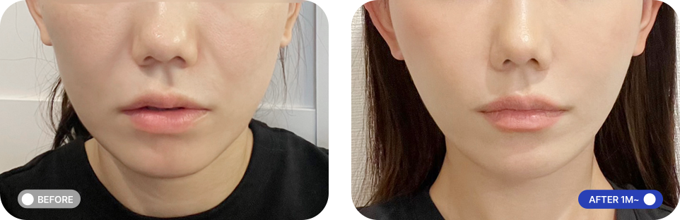 원데이투명리프팅 전후사진