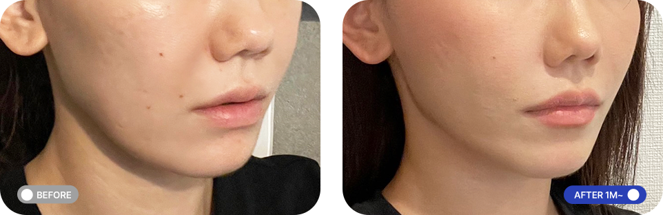 원데이투명리프팅 전후사진