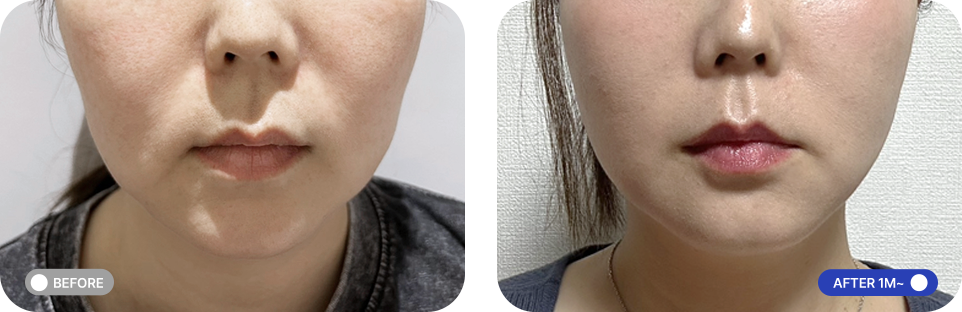 원데이투명리프팅 전후사진