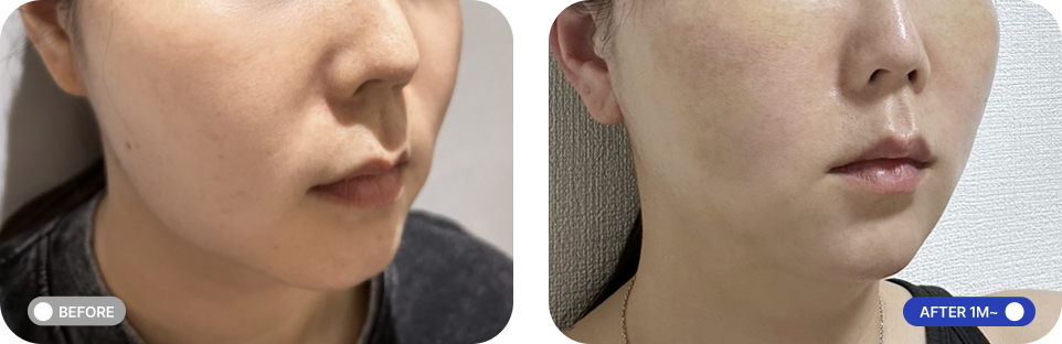 원데이투명리프팅 전후사진