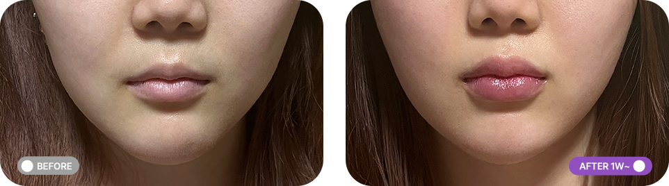 인중축소시술 전후사진