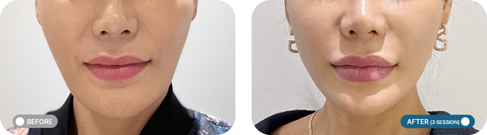 쥬베룩 볼륨 전후사진