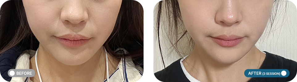 쥬베룩 볼륨 전후사진