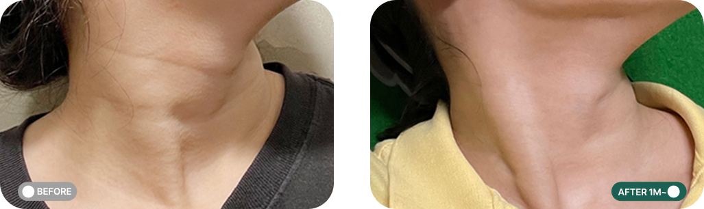 목주름리무버 전후사진