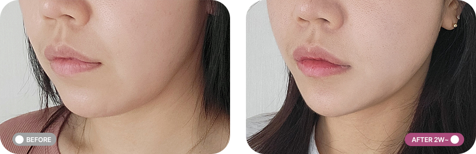 실리프팅 전후사진