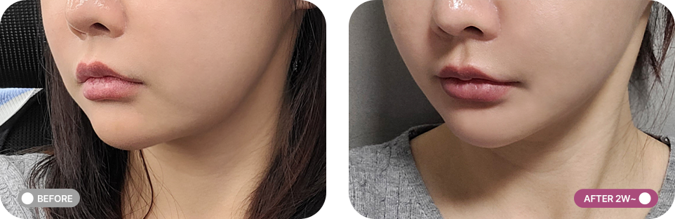 실리프팅 전후사진